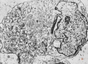 F,55y. | omentum - rhabdomyosarcoma